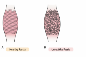 Illustration of a simplified comparison of healthy fascia versus unhealthy fascia